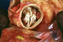 Aortic Valve Disorder Does Not Mean Lower Survival Rates